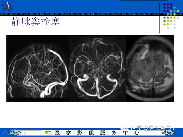 MRI血管造影