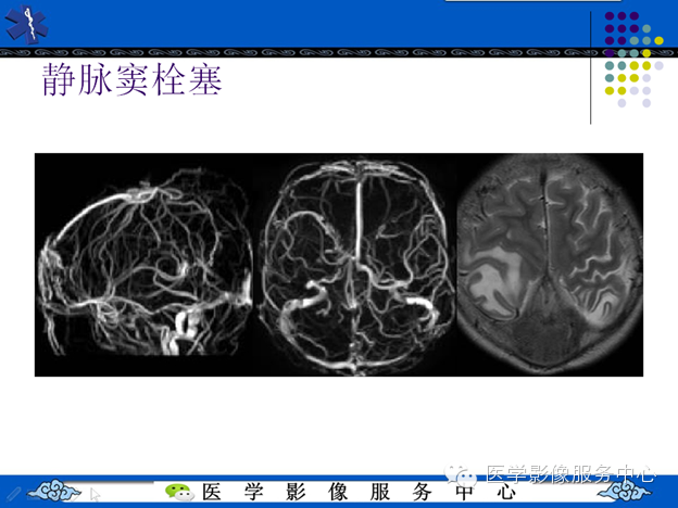 MRI血管造影