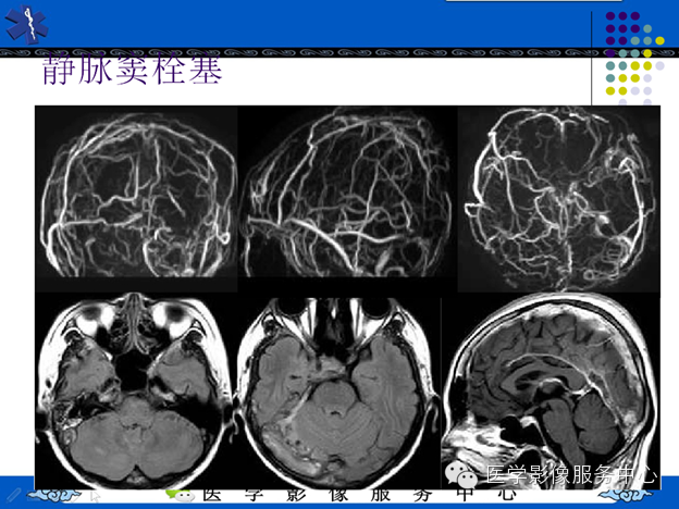 MRI血管造影
