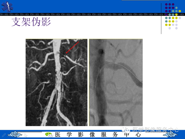 MRI血管造影
