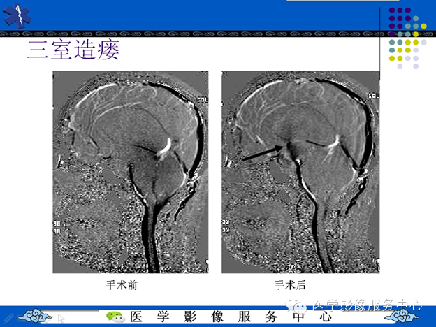 MRI血管造影