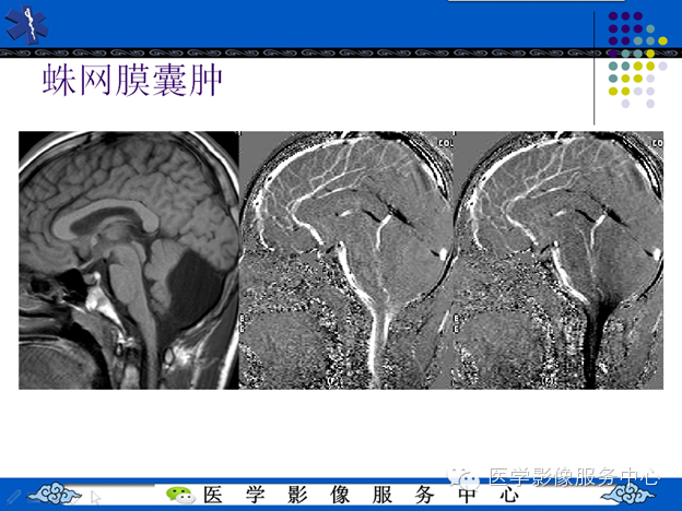 MRI血管造影