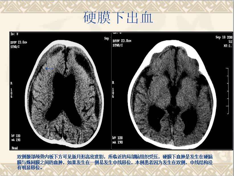 头颈部CT病例读片