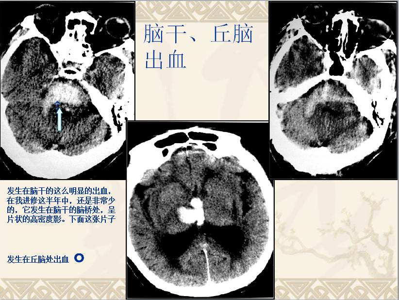 头颈部CT病例读片