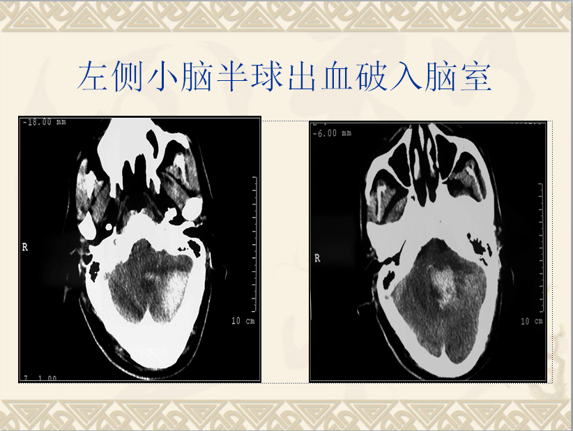 头颈部CT病例读片