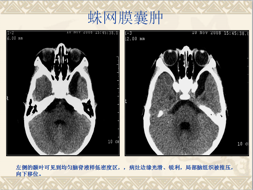 头颈部CT病例读片
