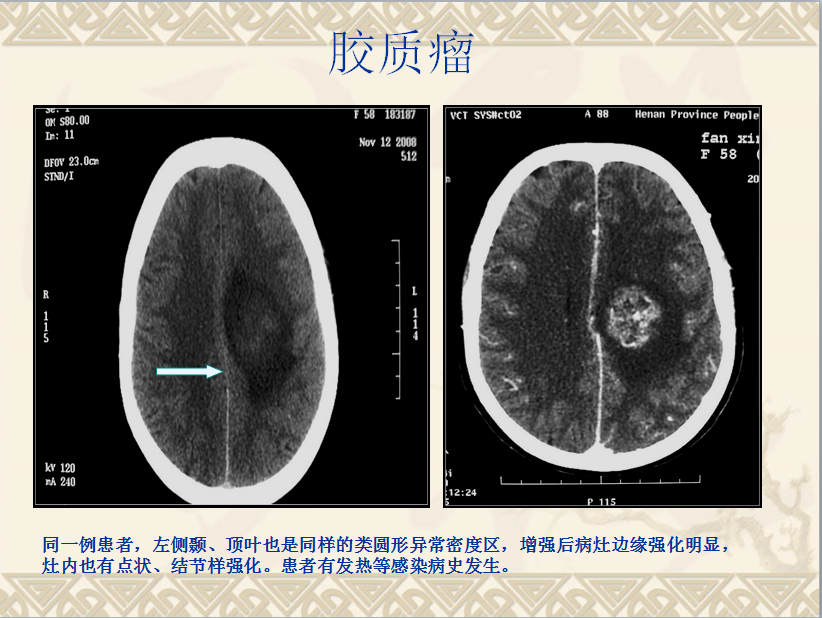 头颈部CT病例读片