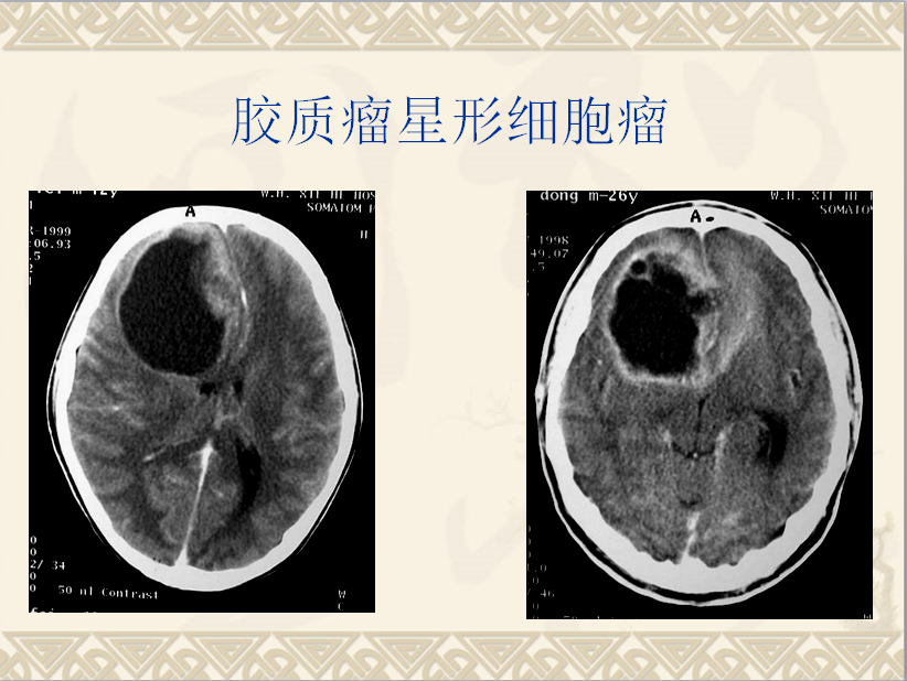 头颈部CT病例读片