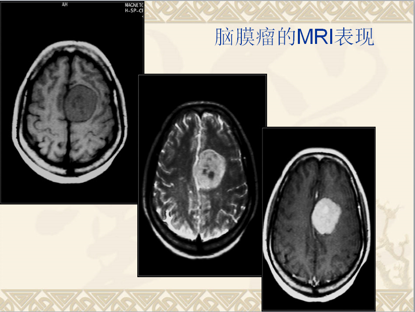 头颈部CT病例读片
