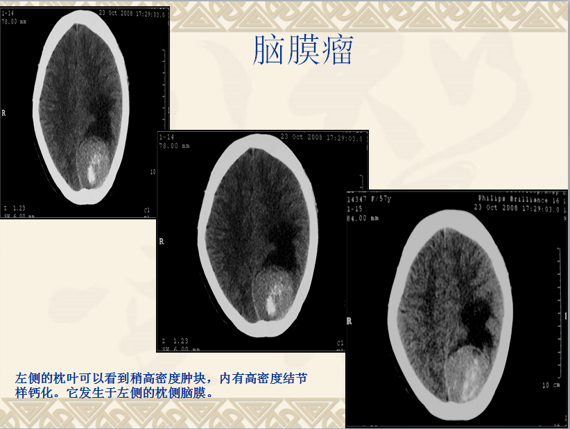 头颈部CT病例读片