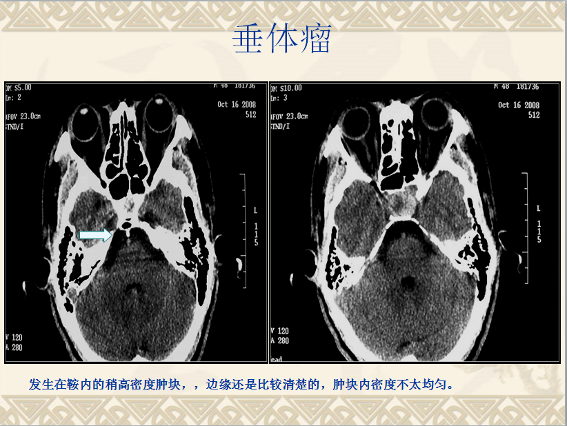 头颈部CT病例读片
