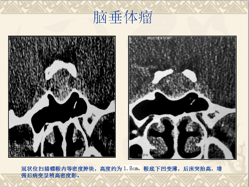 头颈部CT病例读片
