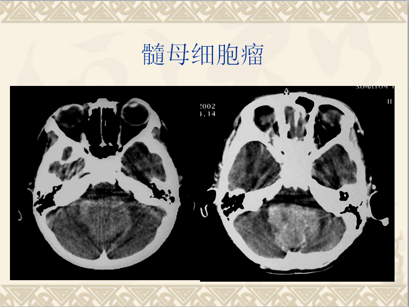 头颈部CT病例读片