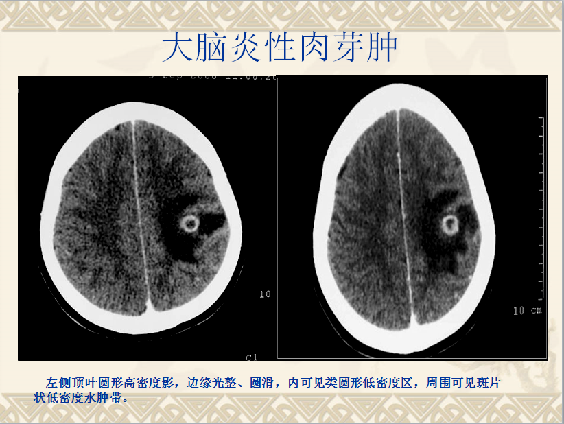 头颈部CT病例读片