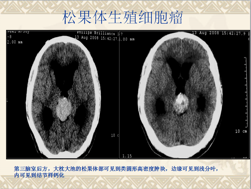 头颈部CT病例读片