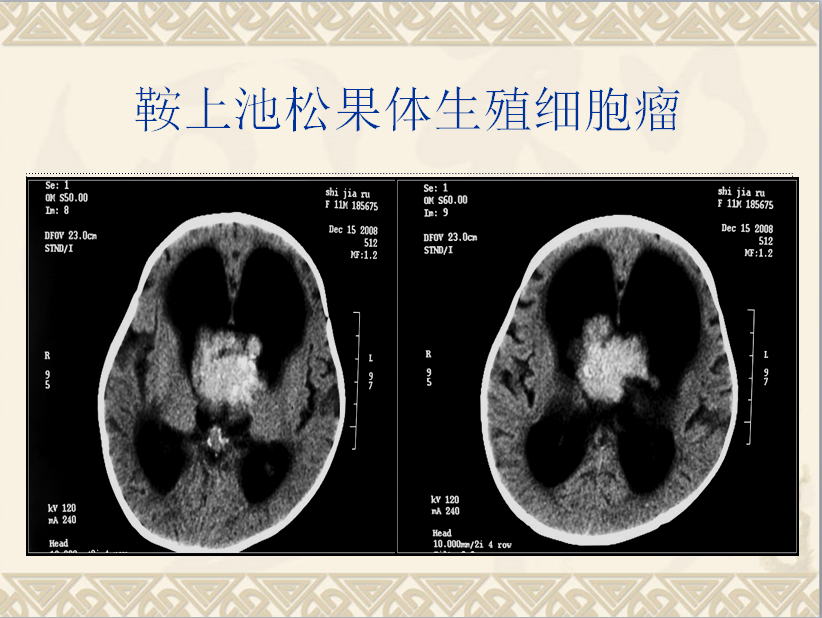 头颈部CT病例读片