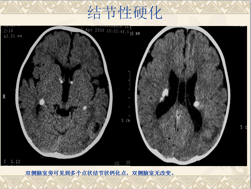 头颈部CT病例读片