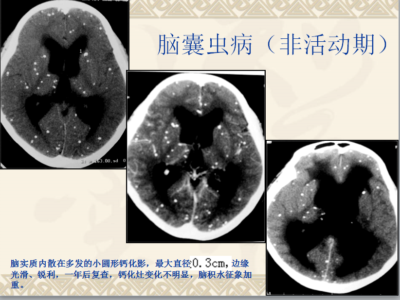 头颈部CT病例读片