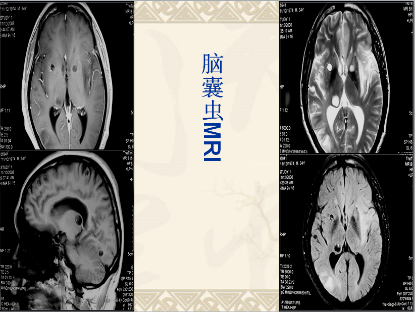 头颈部CT病例读片