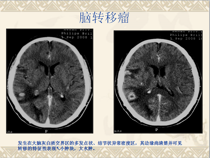 头颈部CT病例读片