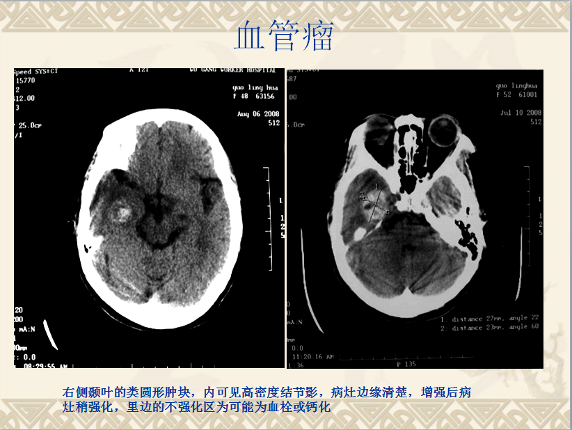 头颈部CT病例读片