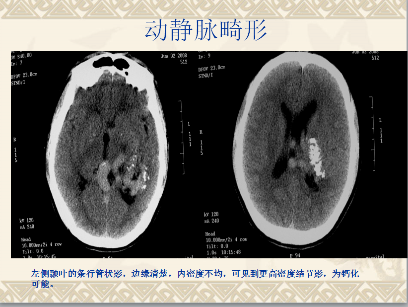 头颈部CT病例读片