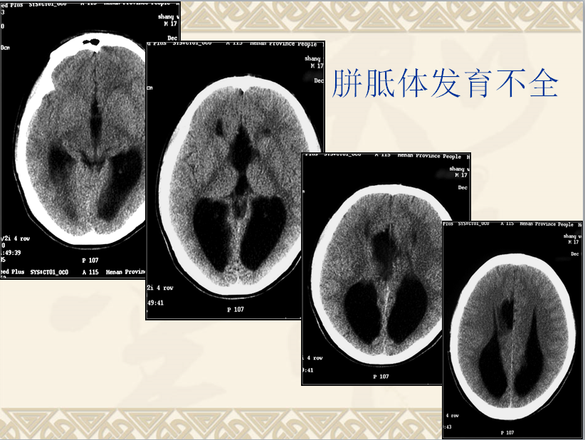 头颈部CT病例读片