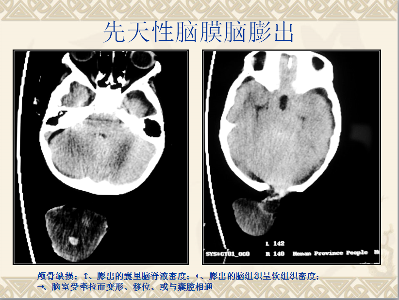 头颈部CT病例读片