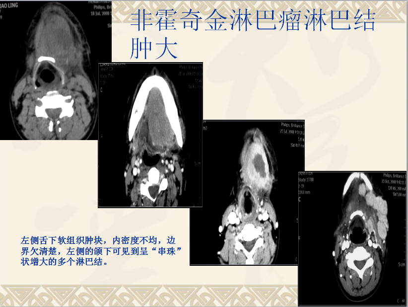 头颈部CT病例读片