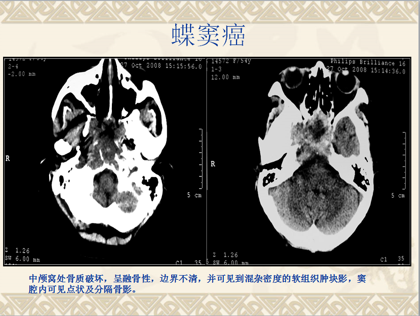 头颈部CT病例读片