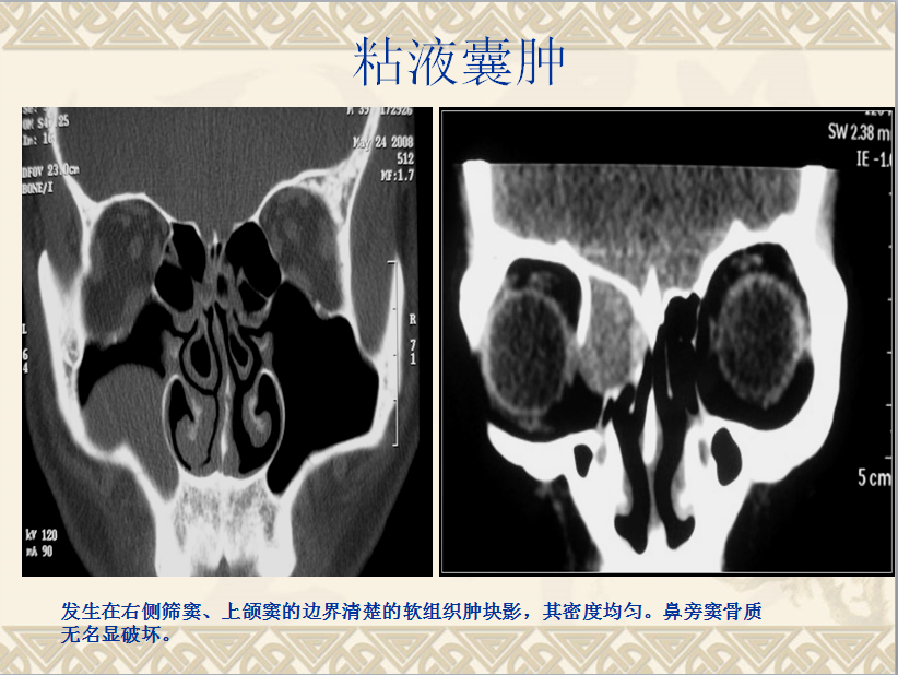 头颈部CT病例读片