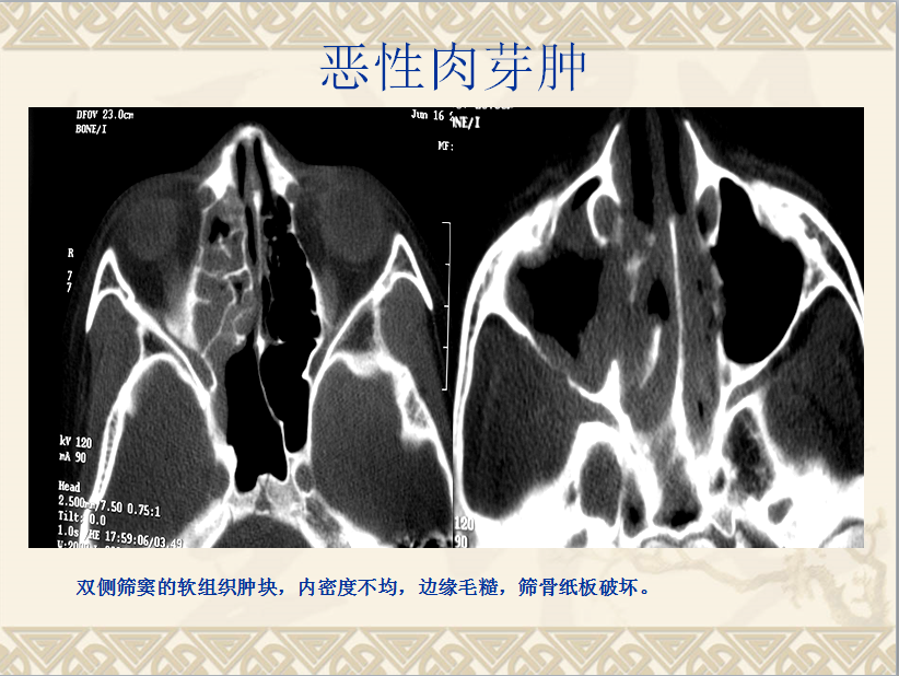 头颈部CT病例读片