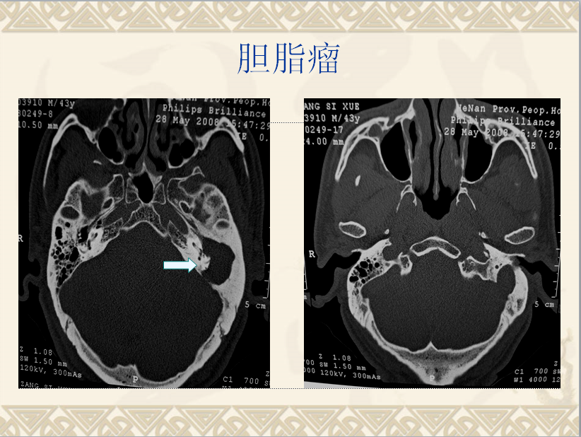 头颈部CT病例读片