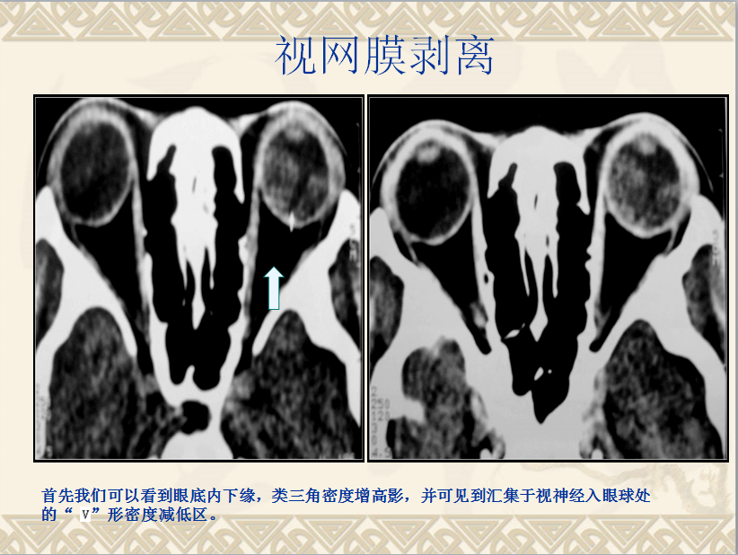 头颈部CT病例读片