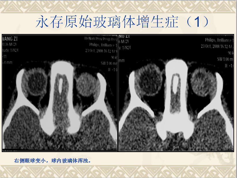 头颈部CT病例读片