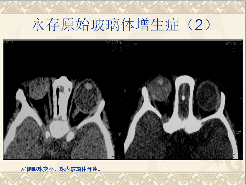 头颈部CT病例读片