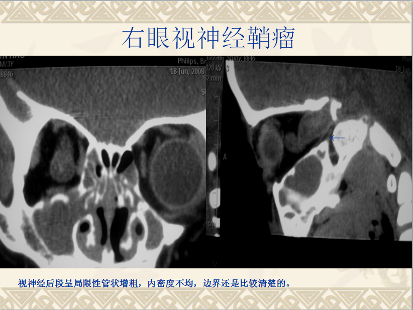 头颈部CT病例读片