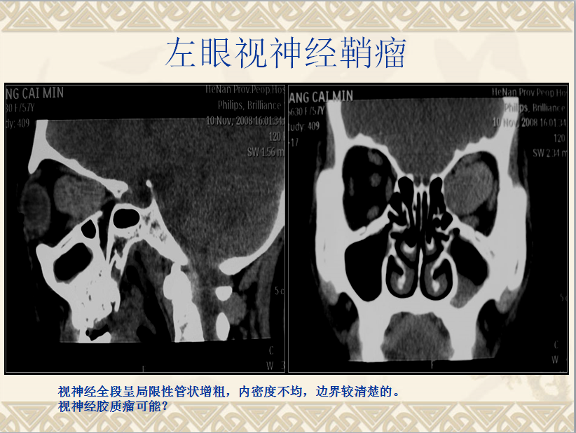 头颈部CT病例读片