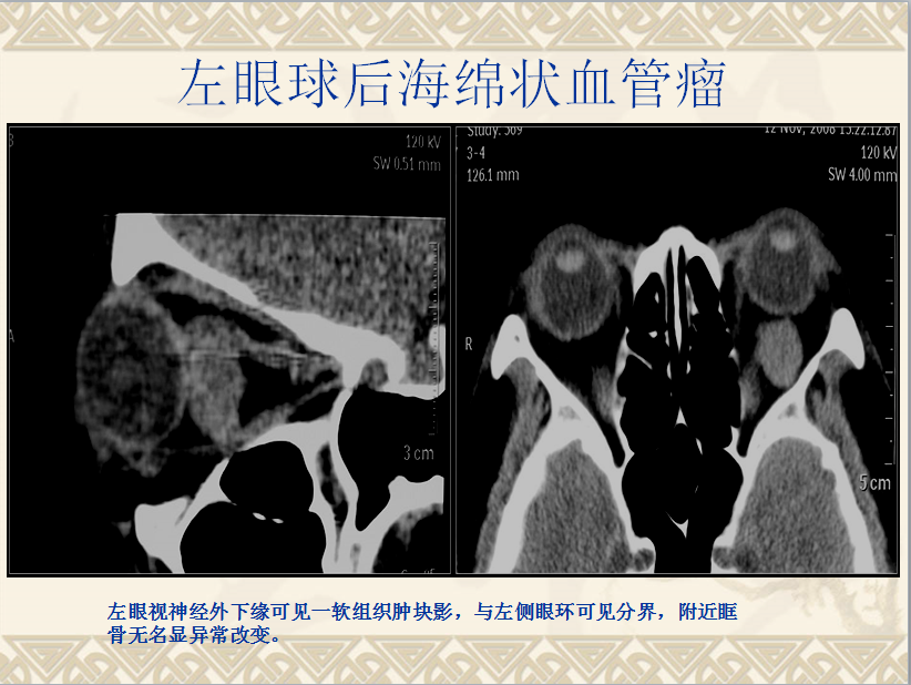 头颈部CT病例读片