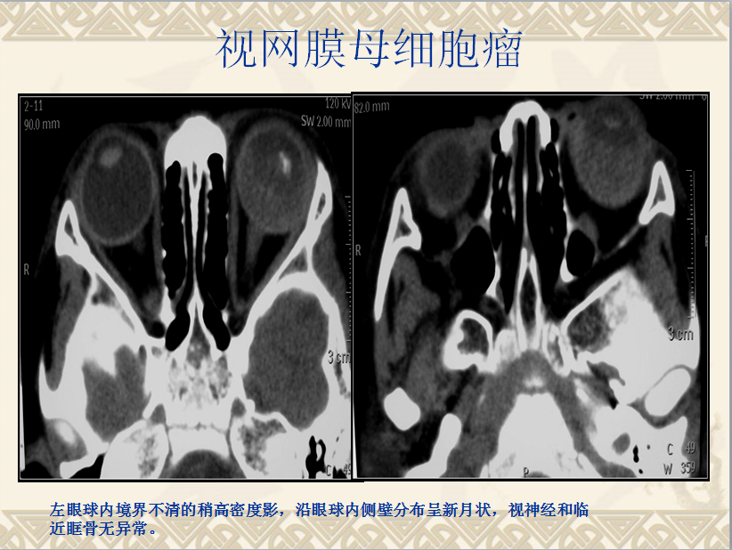 头颈部CT病例读片