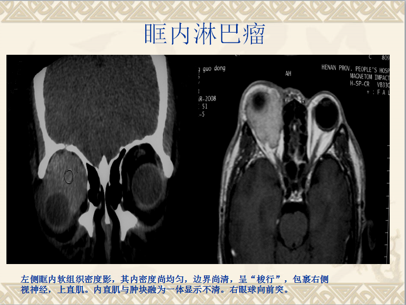 头颈部CT病例读片