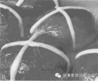 【影像征象系列】十字面包征 【影像征象系列】十字面包征