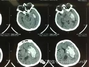头颅CT图片及详解---年轻医师轻松学 头颅CT图片及详解---年轻医师轻松学