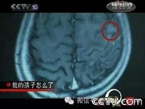 头颅CT图片及详解---年轻医师轻松学 头颅CT图片及详解---年轻医师轻松学