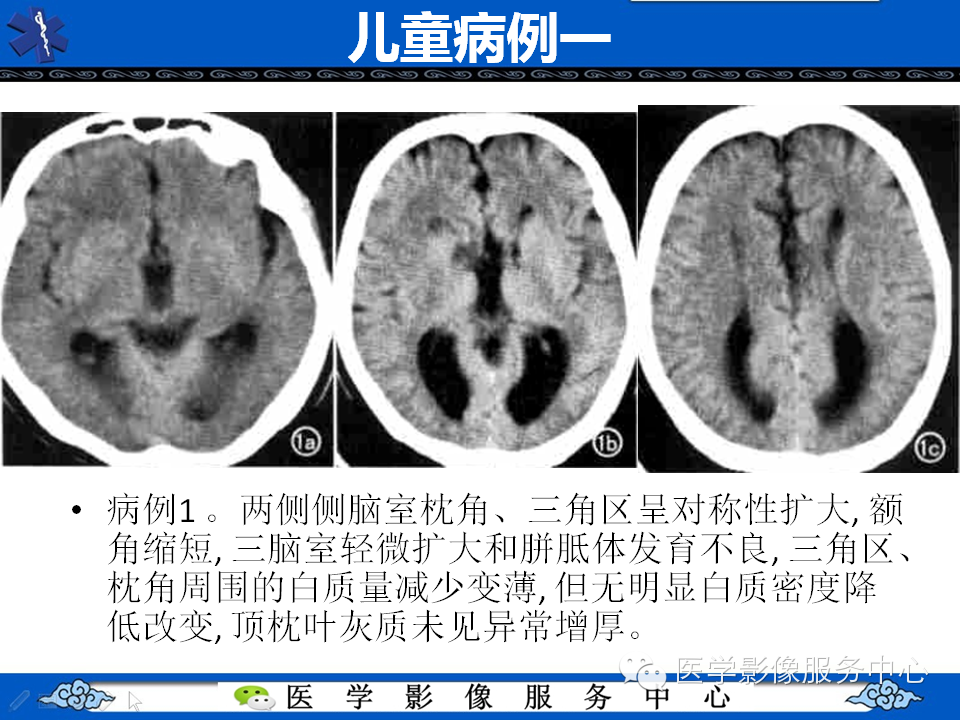 侧脑室枕角扩大畸形