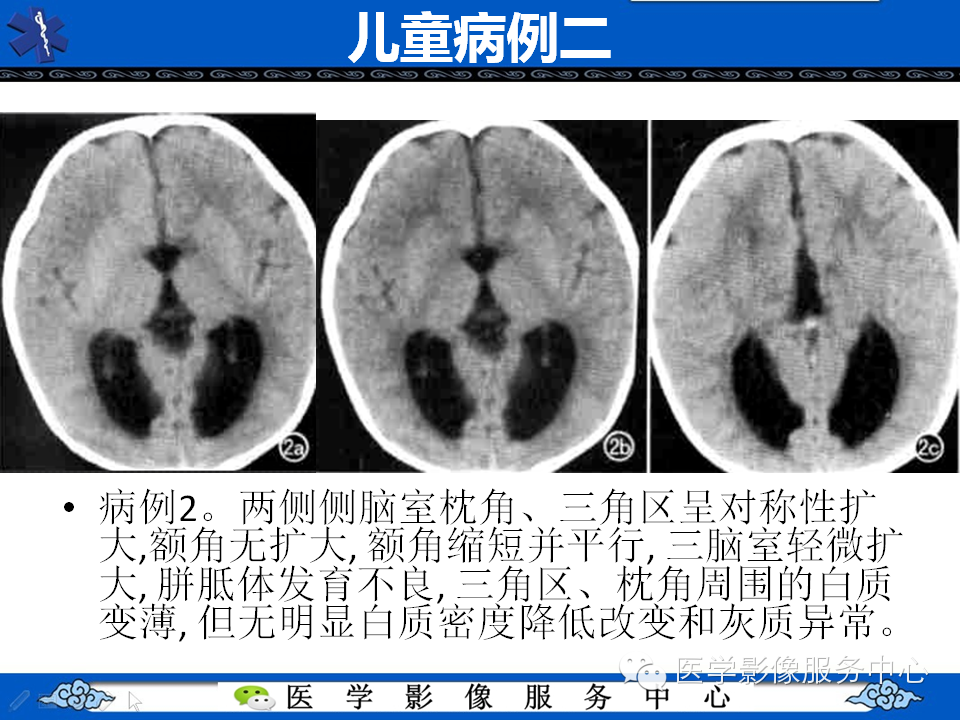 侧脑室枕角扩大畸形