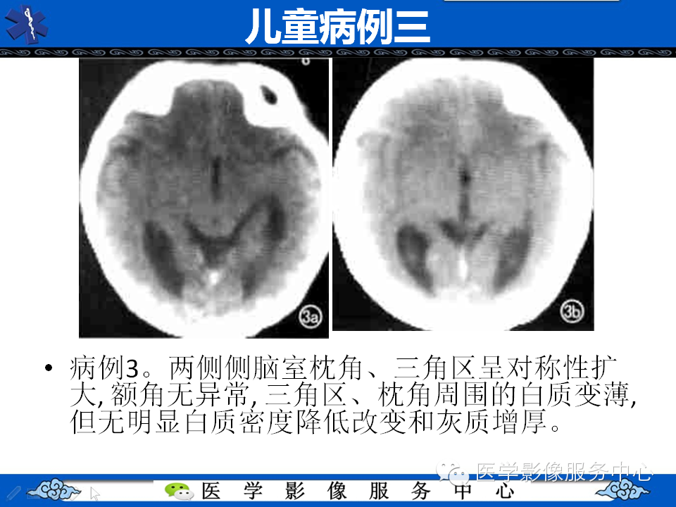 侧脑室枕角扩大畸形
