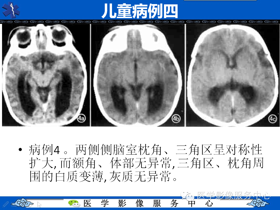 侧脑室枕角扩大畸形