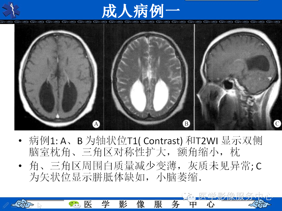 侧脑室枕角扩大畸形