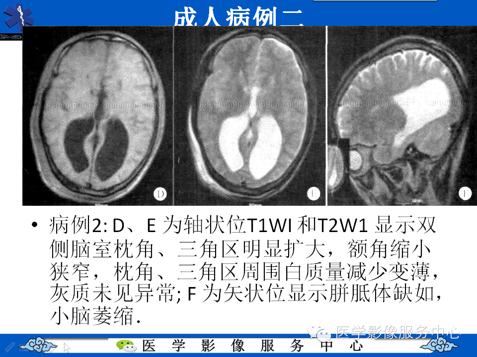 侧脑室枕角扩大畸形